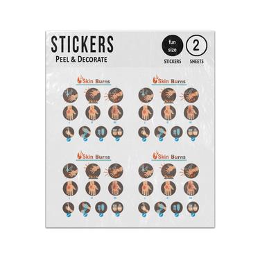 Picture of Skin Burns Types Symptoms Treatments Infographic Sticker Sheets Twin Pack
